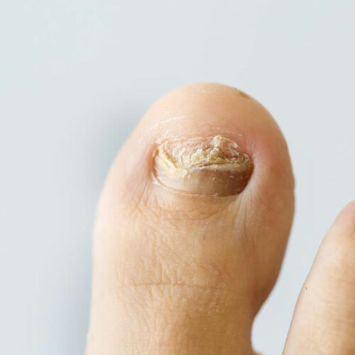 Common nail infections to avoid