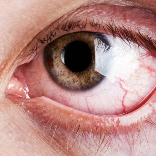 What are the common and rare symptoms of Graves’ disease
