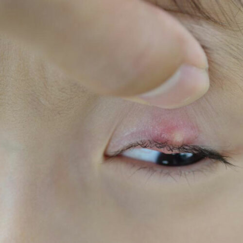 Top home remedies to get rid of blepharitis